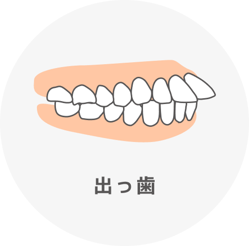 出っ歯