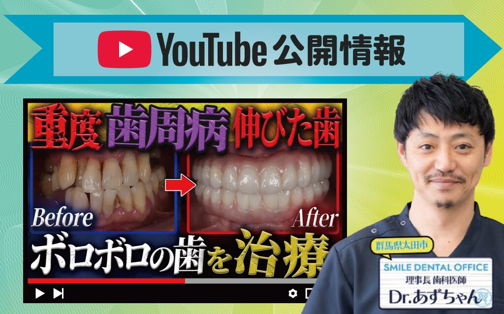 【YouTube動画】重度歯周病で歯が伸びてる&抜け落ちてる患者をインプラントで治療!フルマウスインプラントの治療のポイントなどを歯科医が解説!