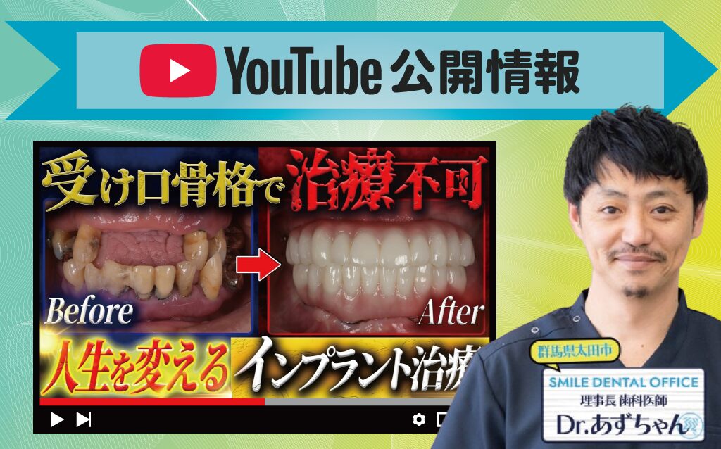 【YouTube】【受け口】他院で断られ続けた患者さんの人生を救ったインプラント治療【抜歯即時インプラント】